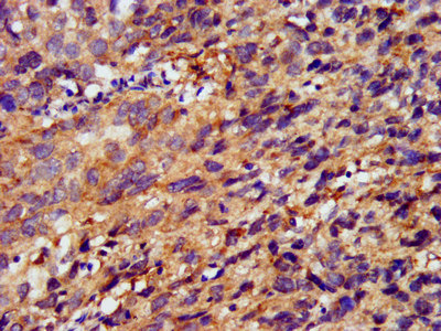 METAP1 Antibody - Immunohistochemistry image at a dilution of 1:400 and staining in paraffin-embedded human ovarian cancer performed on a Leica BondTM system. After dewaxing and hydration, antigen retrieval was mediated by high pressure in a citrate buffer (pH 6.0) . Section was blocked with 10% normal goat serum 30min at RT. Then primary antibody (1% BSA) was incubated at 4 °C overnight. The primary is detected by a biotinylated secondary antibody and visualized using an HRP conjugated SP system.
