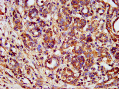 METAP1 Antibody - Immunohistochemistry image at a dilution of 1:400 and staining in paraffin-embedded human pancreatic cancer performed on a Leica BondTM system. After dewaxing and hydration, antigen retrieval was mediated by high pressure in a citrate buffer (pH 6.0) . Section was blocked with 10% normal goat serum 30min at RT. Then primary antibody (1% BSA) was incubated at 4 °C overnight. The primary is detected by a biotinylated secondary antibody and visualized using an HRP conjugated SP system.