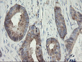 METAP2 Antibody - IHC of paraffin-embedded Adenocarcinoma of Human colon tissue using anti-METAP2 mouse monoclonal antibody.
