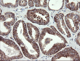 METAP2 Antibody - IHC of paraffin-embedded Carcinoma of Human prostate tissue using anti-METAP2 mouse monoclonal antibody.
