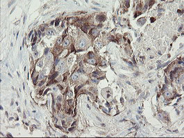 METAP2 Antibody - IHC of paraffin-embedded Adenocarcinoma of Human breast tissue using anti-METAP2 mouse monoclonal antibody.