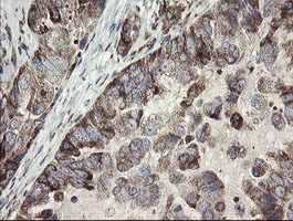 METAP2 Antibody - IHC of paraffin-embedded Adenocarcinoma of Human ovary tissue using anti-METAP2 mouse monoclonal antibody.