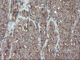 METAP2 Antibody - IHC of paraffin-embedded Carcinoma of Human thyroid tissue using anti-METAP2 mouse monoclonal antibody.
