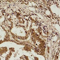 Methyl-Lysine Antibody - Immunohistochemical analysis of Methyl Lysine staining in human breast cancer formalin fixed paraffin embedded tissue section. The section was pre-treated using heat mediated antigen retrieval with sodium citrate buffer (pH 6.0). The section was then incubated with the antibody at room temperature and detected using an HRP conjugated compact polymer system. DAB was used as the chromogen. The section was then counterstained with hematoxylin and mounted with DPX.