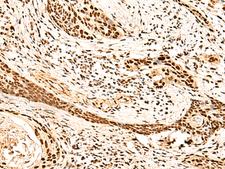 METTL1 Antibody - Immunohistochemistry of paraffin-embedded Human esophagus cancer tissue  using METTL1 Polyclonal Antibody at dilution of 1:50(×200)