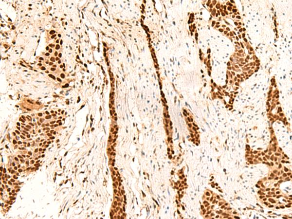METTL1 Antibody - Immunohistochemistry of paraffin-embedded Human esophagus cancer tissue  using METTL1 Polyclonal Antibody at dilution of 1:55(×200)