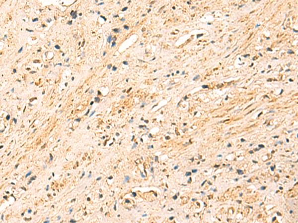 METTL10 Antibody - Immunohistochemistry of paraffin-embedded Human prost at e cancer tissue  using EEF1AKMT2 Polyclonal Antibody at dilution of 1:50(×200)