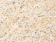 METTL10 Antibody - Immunohistochemistry of paraffin-embedded Human prost at e cancer tissue  using EEF1AKMT2 Polyclonal Antibody at dilution of 1:50(×200)