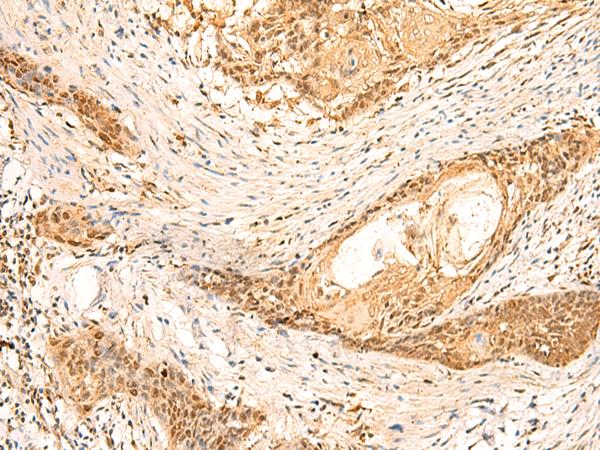 METTL10 Antibody - Immunohistochemistry of paraffin-embedded Human esophagus cancer tissue  using EEF1AKMT2 Polyclonal Antibody at dilution of 1:50(×200)