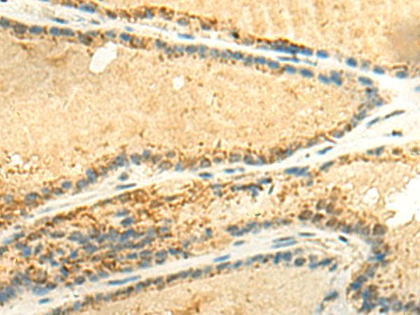 METTL10 Antibody - Immunohistochemistry of paraffin-embedded Human thyroid cancer tissue  using EEF1AKMT2 Polyclonal Antibody at dilution of 1:50(×200)