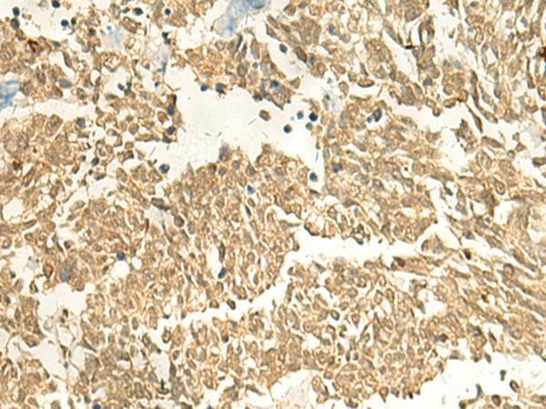 METTL10 Antibody - Immunohistochemistry of paraffin-embedded Human lung cancer tissue  using EEF1AKMT2 Polyclonal Antibody at dilution of 1:50(×200)