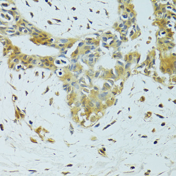 METTL13 / KIAA0859 Antibody - Immunohistochemistry of paraffin-embedded human breast cancer using METTL13 antibody at dilution of 1:100 (40x lens).
