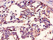 METTL14 Antibody - Immunohistochemistry of paraffin-embedded human gastric cancer using METTL14 Antibody at dilution of 1:100