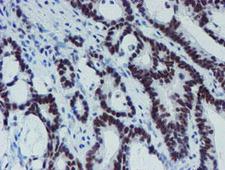 METTL16 / METT10D Antibody - IHC of paraffin-embedded Adenocarcinoma of Human colon tissue using anti-METT10D mouse monoclonal antibody. (Heat-induced epitope retrieval by 10mM citric buffer, pH6.0, 100C for 10min).