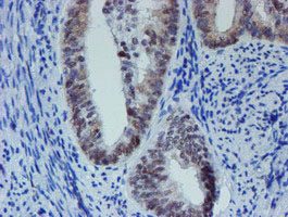 METTL16 / METT10D Antibody - IHC of paraffin-embedded Adenocarcinoma of Human endometrium tissue using anti-METT10D mouse monoclonal antibody. (Heat-induced epitope retrieval by 10mM citric buffer, pH6.0, 100C for 10min).