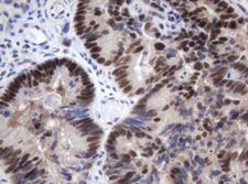 METTL16 / METT10D Antibody - IHC of paraffin-embedded Adenocarcinoma of Human colon tissue using anti-METT10D mouse monoclonal antibody.