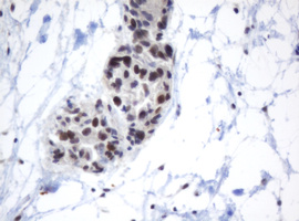 METTL16 / METT10D Antibody - IHC of paraffin-embedded Adenocarcinoma of Human ovary tissue using anti-METT10D mouse monoclonal antibody.
