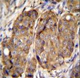 METTL2B Antibody - METTL2 Antibody immunohistochemistry of formalin-fixed and paraffin-embedded human breast carcinoma followed by peroxidase-conjugated secondary antibody and DAB staining.