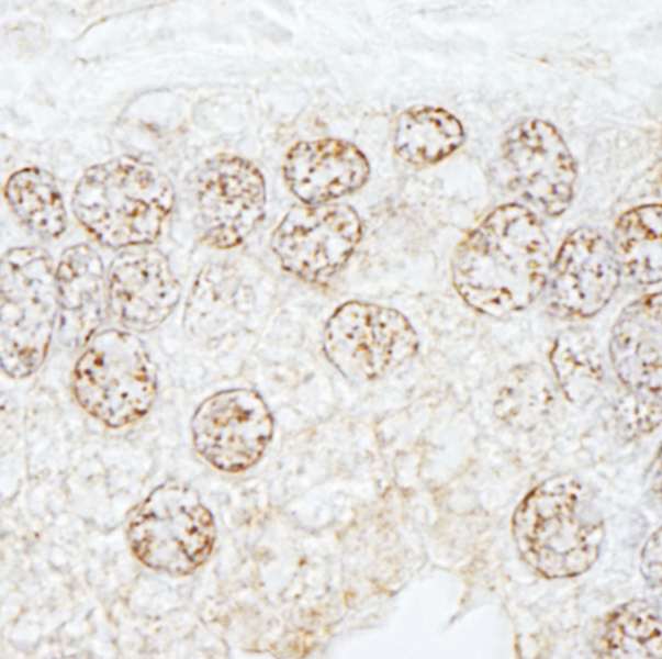 METTL3 Antibody - Detection of Human METTL3/MT-A70 by Immunohistochemistry. Sample: FFPE section of human prostate carcinoma. Antibody: Affinity purified rabbit anti-METTL3/MT-A70 used at a dilution of 1:1000 (0.2 ug/ml). Detection: DAB.