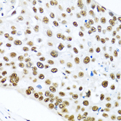 METTL3 Antibody - Immunohistochemistry of paraffin-embedded human lung cancer tissue.