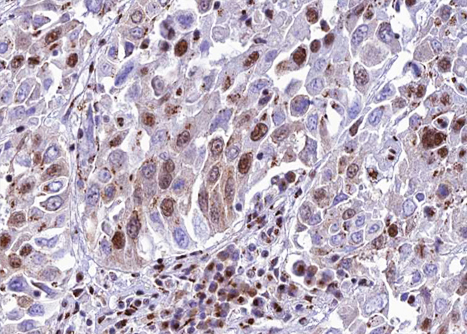 METTL3 Antibody - 1:100 staining human lung carcinoma tissue by IHC-P. The tissue was formaldehyde fixed and a heat mediated antigen retrieval step in citrate buffer was performed. The tissue was then blocked and incubated with the antibody for 1.5 hours at 22°C. An HRP conjugated goat anti-rabbit antibody was used as the secondary.