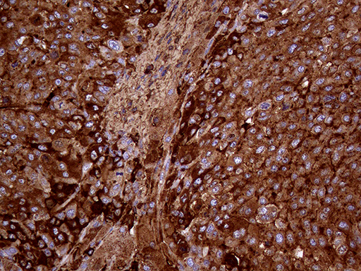 METTL7A Antibody - Immunohistochemical staining of paraffin-embedded Carcinoma of Human liver tissue using anti-METTL7A mouse monoclonal antibody. (Heat-induced epitope retrieval by 1mM EDTA in 10mM Tris buffer. (pH8.5) at 120°C for 3 min. (1:2000)