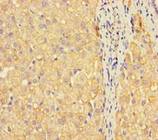 METTL7A Antibody - Immunohistochemistry of paraffin-embedded human liver cancer using METTL7A Antibody at dilution of 1:100