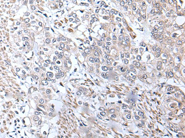 METTL7A Antibody - Immunohistochemistry of paraffin-embedded Human prost ate cancer tissue  using METTL7A Polyclonal Antibody at dilution of 1:40(×200)