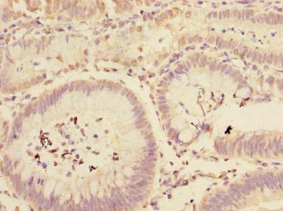 MFAP3L / NYD-Sp9 Antibody - Immunohistochemistry of paraffin-embedded human colon cancer using antibody at dilution of 1:100.