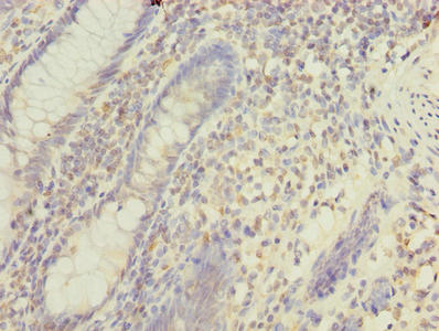 MFAP3L / NYD-Sp9 Antibody - Immunohistochemistry of paraffin-embedded human colon cancer using MFAP3L Antibody at dilution of 1:100