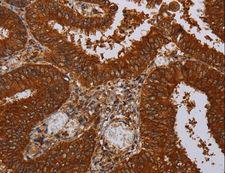 MFAP3L / NYD-Sp9 Antibody - Immunohistochemistry of paraffin-embedded Human liver cancer using MFAP3L Polyclonal Antibody at dilution of 1:50.