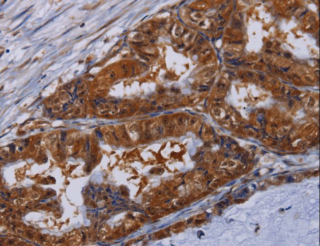 MFAP3L / NYD-Sp9 Antibody - Immunohistochemistry of paraffin-embedded Human esophagus cancer using MFAP3L Polyclonal Antibody at dilution of 1:50.