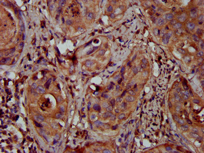 MFAP4 Antibody - Immunohistochemistry image at a dilution of 1:300 and staining in paraffin-embedded human cervical cancer performed on a Leica BondTM system. After dewaxing and hydration, antigen retrieval was mediated by high pressure in a citrate buffer (pH 6.0) . Section was blocked with 10% normal goat serum 30min at RT. Then primary antibody (1% BSA) was incubated at 4 °C overnight. The primary is detected by a biotinylated secondary antibody and visualized using an HRP conjugated SP system.