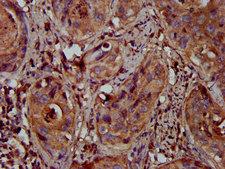 MFAP4 Antibody - Immunohistochemistry image at a dilution of 1:300 and staining in paraffin-embedded human cervical cancer performed on a Leica BondTM system. After dewaxing and hydration, antigen retrieval was mediated by high pressure in a citrate buffer (pH 6.0) . Section was blocked with 10% normal goat serum 30min at RT. Then primary antibody (1% BSA) was incubated at 4 °C overnight. The primary is detected by a biotinylated secondary antibody and visualized using an HRP conjugated SP system.