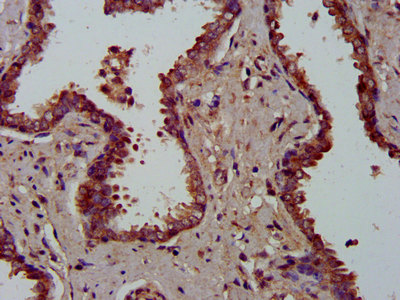 MFAP4 Antibody - Immunohistochemistry image at a dilution of 1:300 and staining in paraffin-embedded human prostate cancer performed on a Leica BondTM system. After dewaxing and hydration, antigen retrieval was mediated by high pressure in a citrate buffer (pH 6.0) . Section was blocked with 10% normal goat serum 30min at RT. Then primary antibody (1% BSA) was incubated at 4 °C overnight. The primary is detected by a biotinylated secondary antibody and visualized using an HRP conjugated SP system.