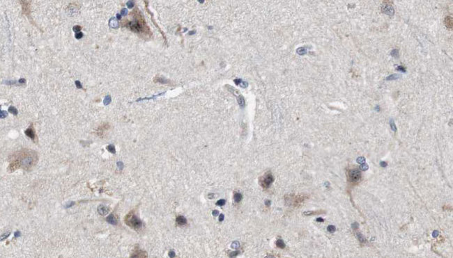 MFF Antibody - 1:100 staining human brain carcinoma tissue by IHC-P. The sample was formaldehyde fixed and a heat mediated antigen retrieval step in citrate buffer was performed. The sample was then blocked and incubated with the antibody for 1.5 hours at 22°C. An HRP conjugated goat anti-rabbit antibody was used as the secondary.