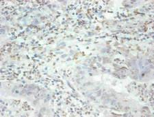 MFGE8 /Lactadherin Antibody - Immunohistochemical of paraffin-embedded human breast cancer tissue using MFGE8 Monoclonal Antibody at dilution of 1:200