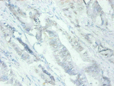 MFGE8 /Lactadherin Antibody - Immunohistochemical of paraffin-embedded human Colon cancer tissues using MFGE8 Monoclonal Antibody at dilution of 1:200