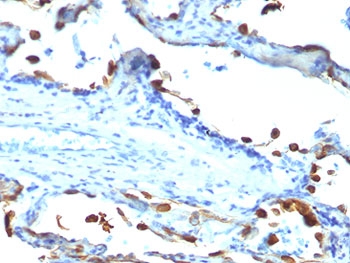 MFGE8 /Lactadherin Antibody - FFPE human lung carcinoma tested with Lactadherin antibody (EDM45).  This image was taken for the unmodified form of this product. Other forms have not been tested.