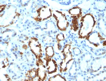 MFGE8 /Lactadherin Antibody - FFPE human renal cell carcinoma tested with Lactadherin antibody (EDM45).  This image was taken for the unmodified form of this product. Other forms have not been tested.