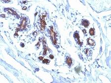 MFGE8 /Lactadherin Antibody - Formalin-fixed, paraffin-embedded human breast carcinoma stained with Lactadherin antibody (EDM45).  This image was taken for the unmodified form of this product. Other forms have not been tested.