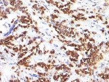 MFGE8 /Lactadherin Antibody - Formalin-fixed, paraffin-embedded human breast carcinoma stained with MFGE8 antibody (MFG-06).  This image was taken for the unmodified form of this product. Other forms have not been tested.