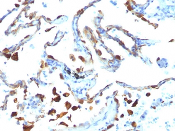 MFGE8 /Lactadherin Antibody - FFPE human lung carcinoma tested with MFGE8 antibody (MFG-06).  This image was taken for the unmodified form of this product. Other forms have not been tested.