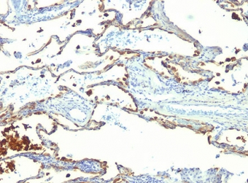 MFGE8 /Lactadherin Antibody - FFPE human lung carcinoma tested with MFG-E8 antibody (SPM291).  This image was taken for the unmodified form of this product. Other forms have not been tested.