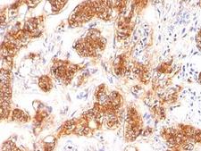 MFGE8 /Lactadherin Antibody - Formalin-fixed, paraffin-embedded human breast carcinoma stained with MFG-E8 antibody (SPM291).  This image was taken for the unmodified form of this product. Other forms have not been tested.