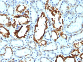 MFGE8 /Lactadherin Antibody - FFPE human renal cell carcinoma tested with MFG-E8 antibody (SPM291).  This image was taken for the unmodified form of this product. Other forms have not been tested.