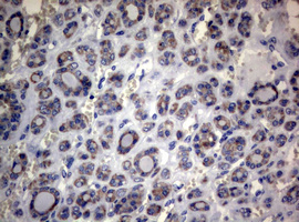 MFN1 Antibody - IHC of paraffin-embedded Carcinoma of Human thyroid tissue using anti-MFN1 mouse monoclonal antibody.