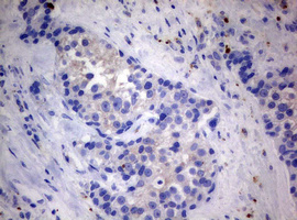 MFN1 Antibody - IHC of paraffin-embedded Adenocarcinoma of Human breast tissue using anti-MFN1 mouse monoclonal antibody.
