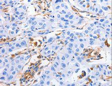 MFN1 Antibody - Immunohistochemistry of paraffin-embedded Human lung cancer using MFN1 Polyclonal Antibody at dilution of 1:60.