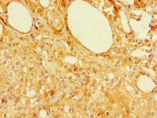 MFSD5 Antibody - Immunohistochemistry of paraffin-embedded human prostate cancer using MFSD5 Antibody at dilution of 1:100